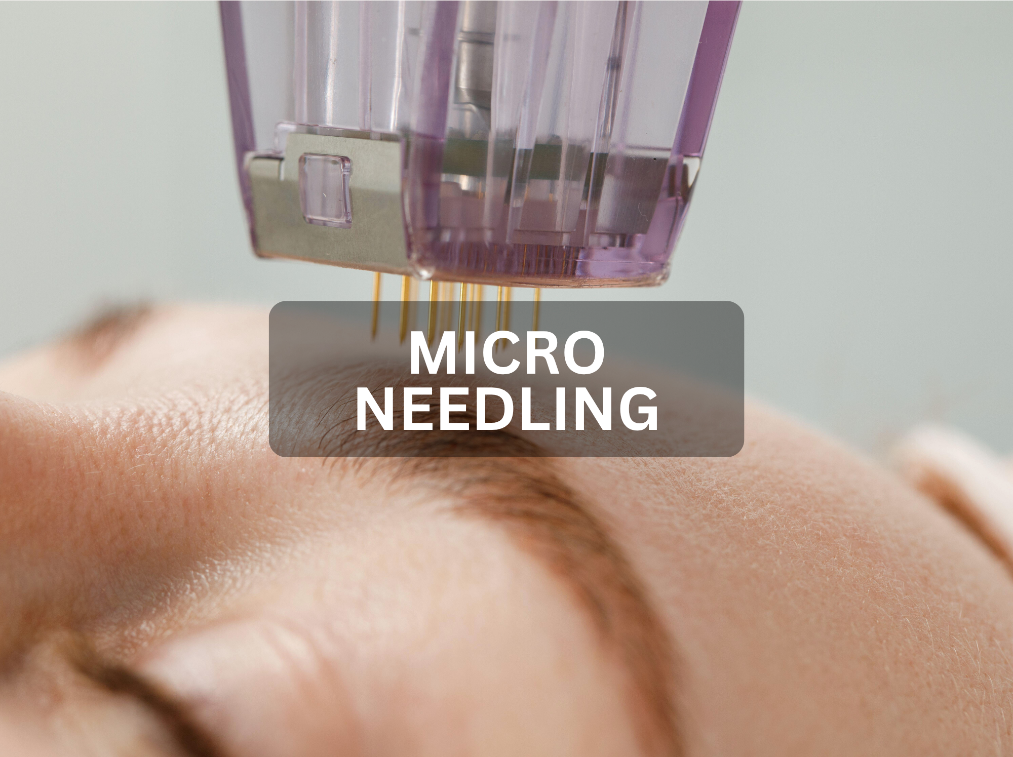 Micro Needling